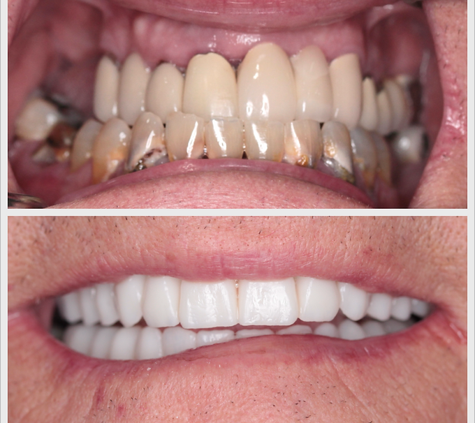 full arch dental implant ba1