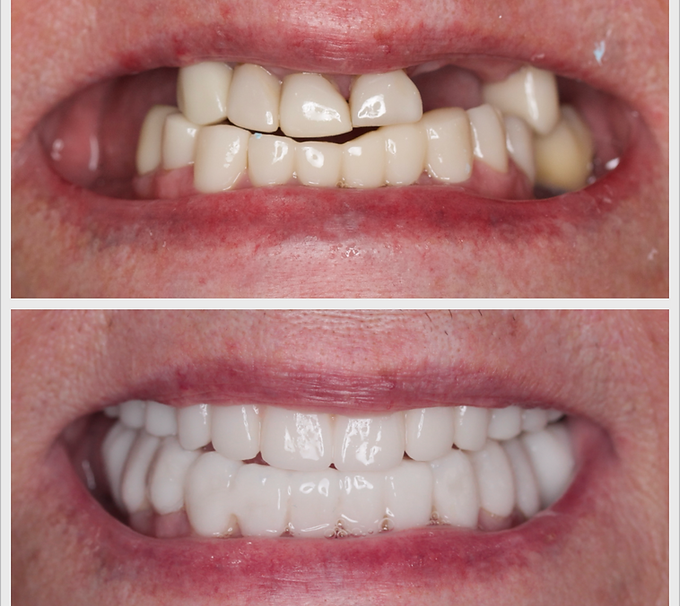 full arch dental implant ba2