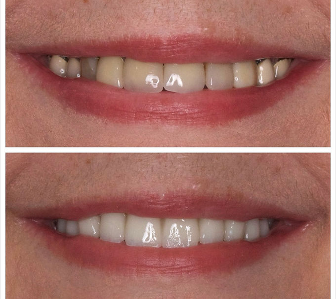 dental veneer before after ba 3
