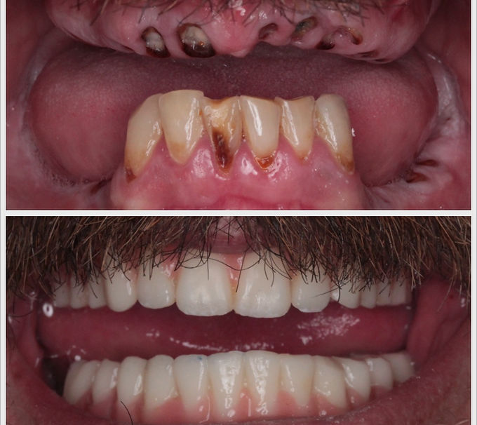 full arch dental implant ba4