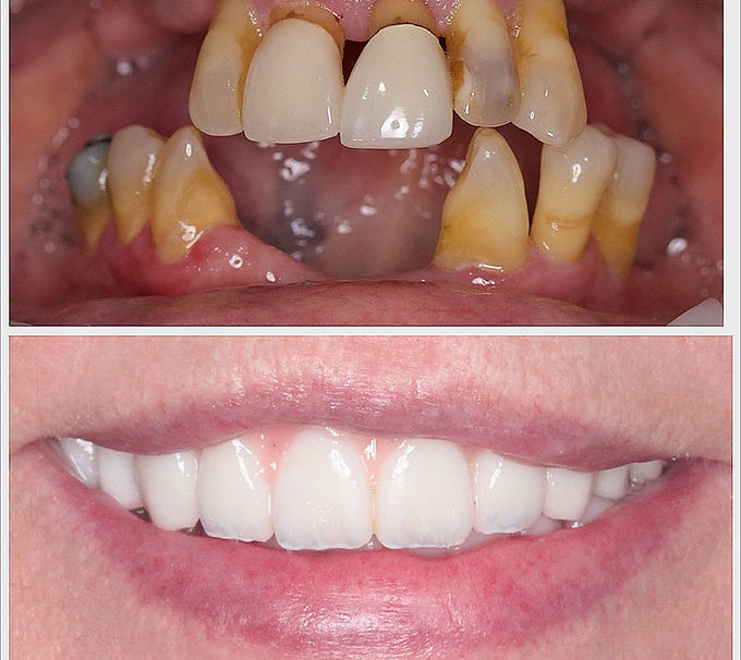 full arch dental implant ba 5