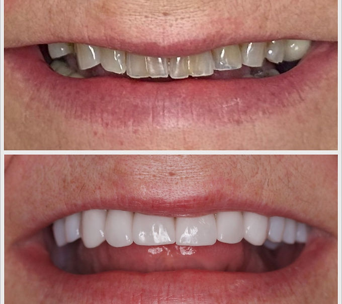 dental veneer before after ba 6