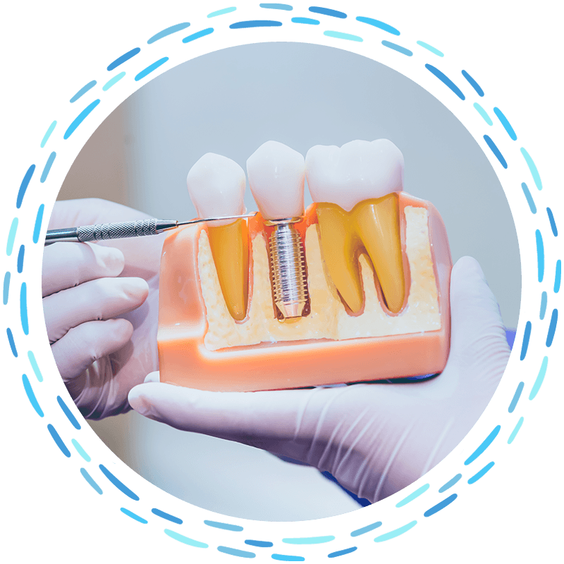 dental implant model real